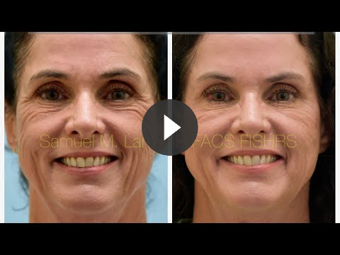 Dynamic Filler, MesoBotox Testimonial