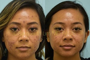 MesoTox Results Dallas